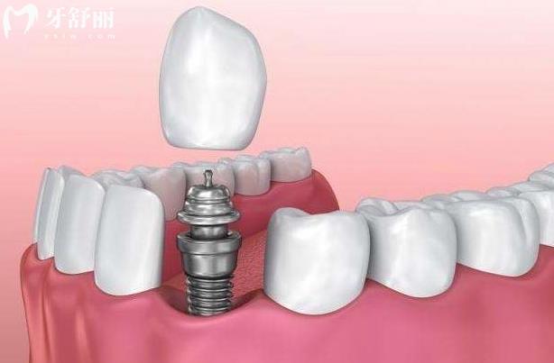 杭州下沙口腔医院哪家好?推荐排名前十的牙科有瑞创/佳尔仕/雅乐口腔等都很正规口碑好