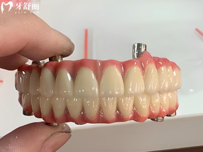 九江口腔医院2026新收费标准曝光:种植牙2800+矫正6800+牙齿美白1000+