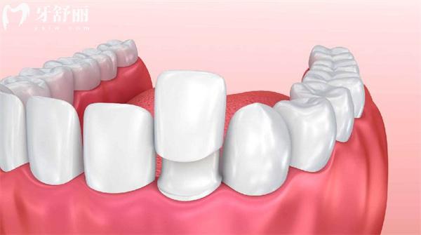 深圳牙齿贴片价格表