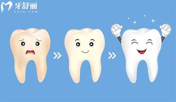 深圳牙齿贴片多少钱