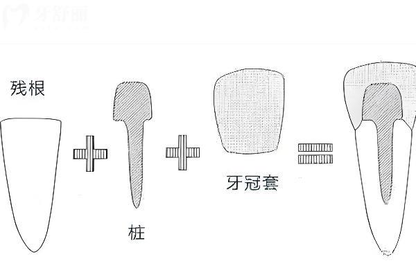 戴牙冠打桩哪种桩好
