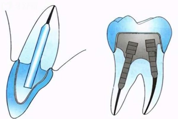 戴牙冠打桩哪种桩好