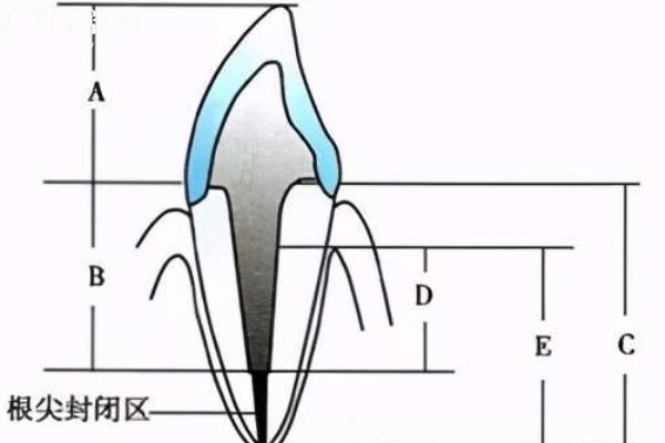 戴牙冠打桩哪种桩好