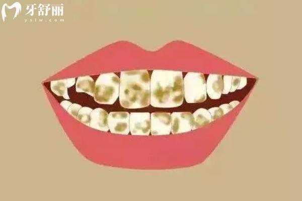 牙齿美白能提升几个色阶