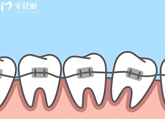 美国奥美科(Ormco)自锁托槽有几个系列?7大系列大揭秘:技术/价格,选对不踩雷