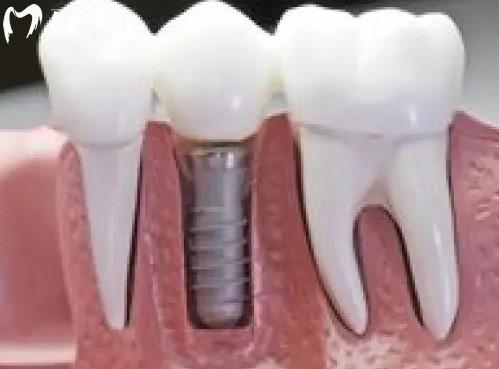 北京朝阳区种牙到底多少钱一颗啊