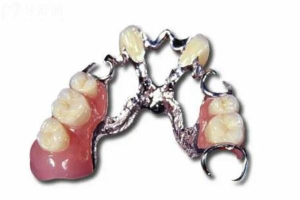 活动牙支架的材料都有哪些