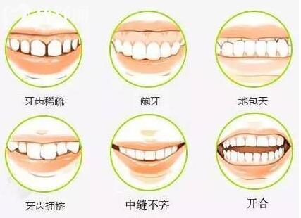 牙齿矫正多少钱2026全新价格表:金属、自锁、隐形、舌侧牙套怎么选?