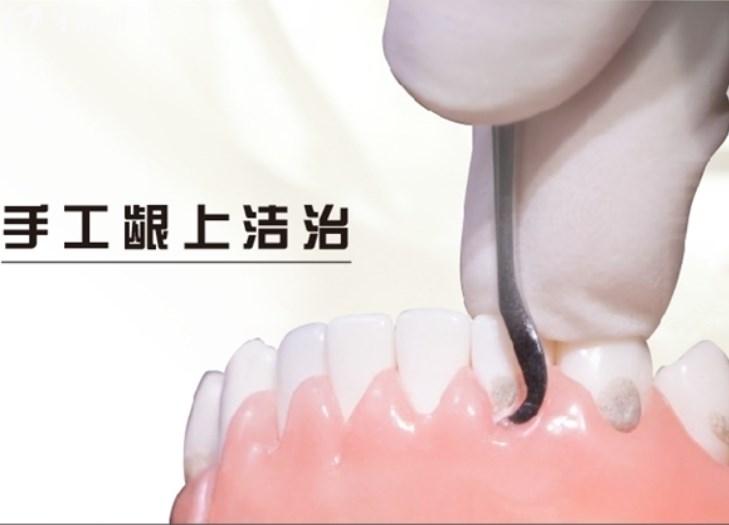 龈下刮治.jpg
