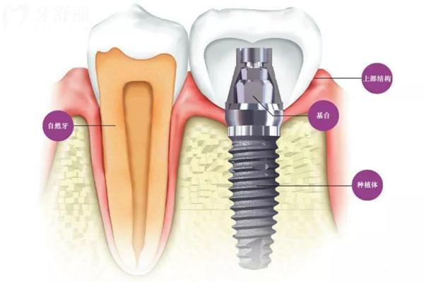 威士达福种植体是哪个国的
