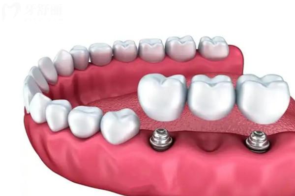 牙齿搭桥可以维持多久？两边牙需要磨多少？