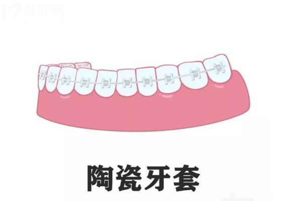 陶瓷自锁托槽哪个品牌好