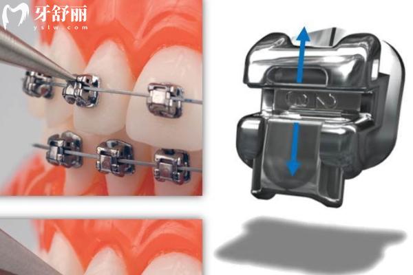 陶瓷自锁托槽哪个品牌好