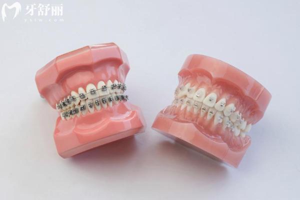 陶瓷自锁托槽哪个品牌好