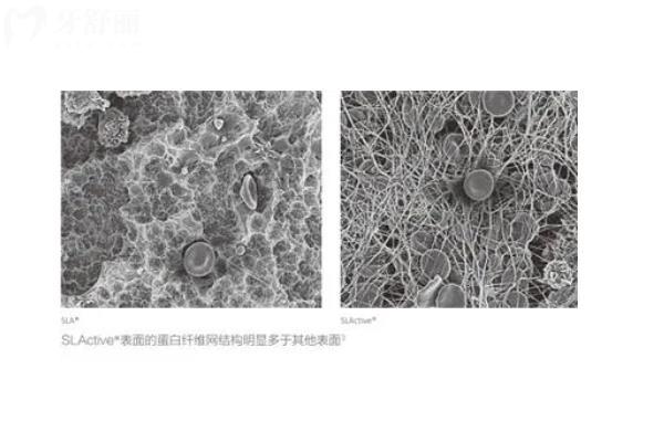 韩国美格真种植体材质