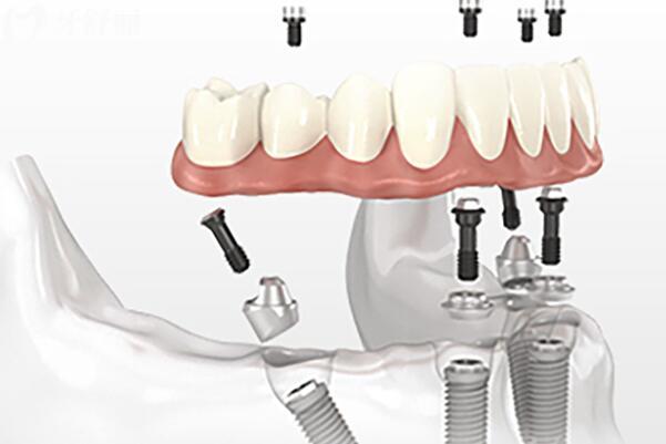 全新博爱口腔2026价格表尽览:韩系种植1880+/金属矫正6800+/拔智齿268+/补牙99+