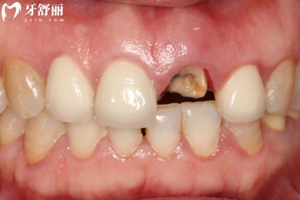 大门牙掉了不补有什么影响？