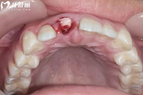 大门牙掉了不补有什么影响？