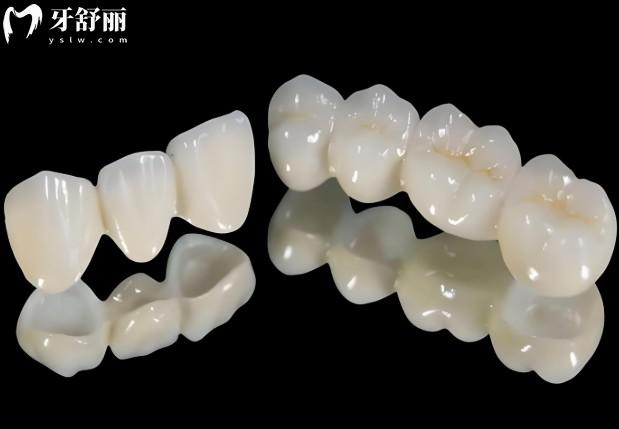 纯钛牙和全瓷牙哪种要贵一些?价格大PK,看完不纠结选哪个更划算