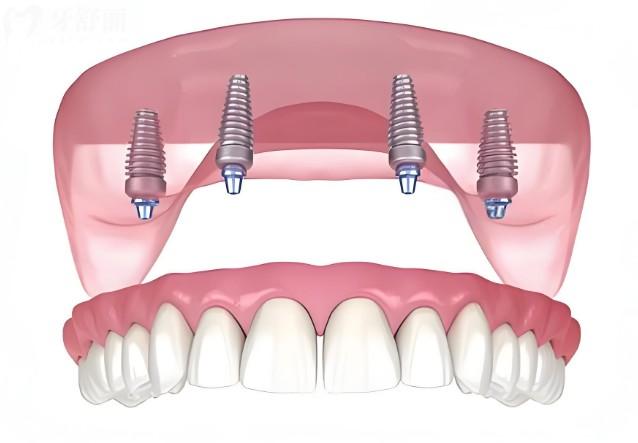 【2026珠海种植牙价格表全解析】单颗/半口/全口真实报价！5家种牙人气牙科大公开