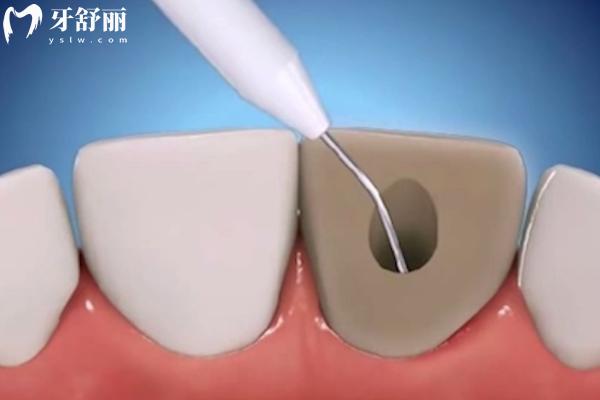 根管治疗一般要做几次？收几次的钱？