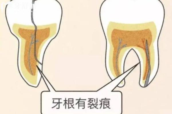 已经隐裂的牙齿能自愈吗？