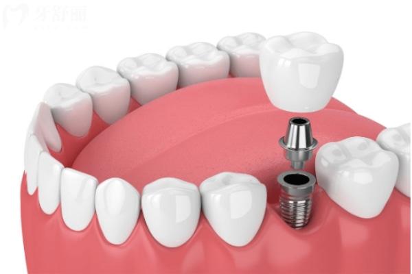 当地患者分享保定便宜又好的牙科排名