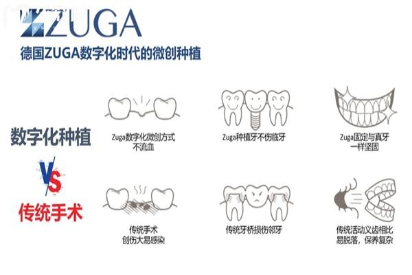 德国zuga种植体的优势有哪些