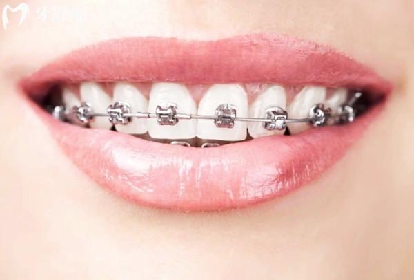 戴牙套矫正牙齿一般需要多少钱