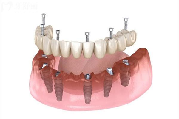 老年人满口牙全换要多少钱？