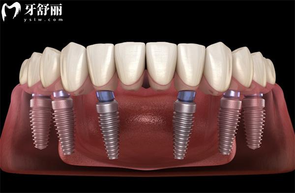 扒一扒德国赛弗Xive种植牙型号有什么?TG/S型号+价格寿命大揭秘,看完不踩坑！