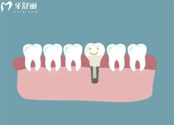 扒一扒德国赛弗Xive种植牙型号有什么?TG/S型号+价格寿命大揭秘,看完不踩坑！