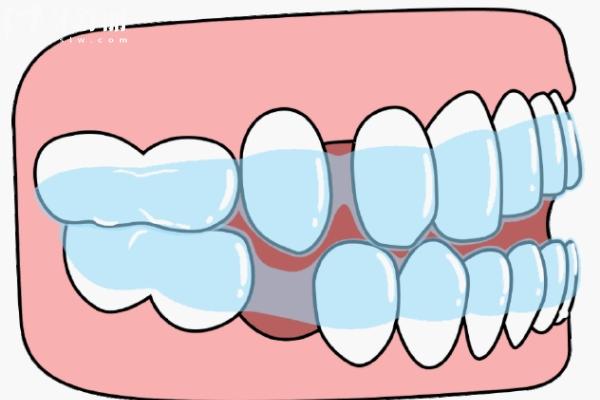 牙套矫正大概要花费多少钱