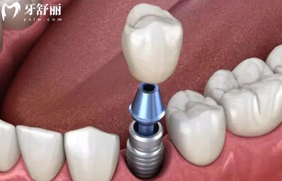 全新慈溪植帆口腔2026收费价目表尽览：种植牙2499元+自锁矫正9000元+根管治疗580元起