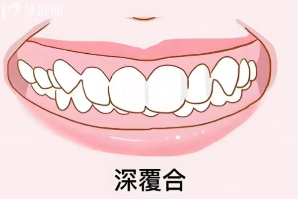 闭锁性深覆合矫正难治吗？