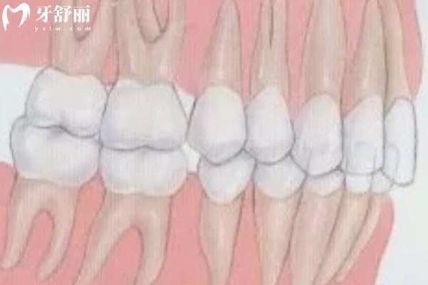 闭锁性深覆合矫正难治吗？