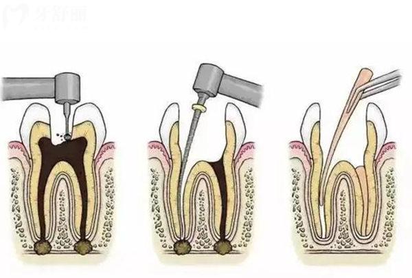 2026天津做根管治疗详细价格表!前门牙后牙儿牙价格全公开,附十大靠谱医院地址,绝绝子攻略速存！