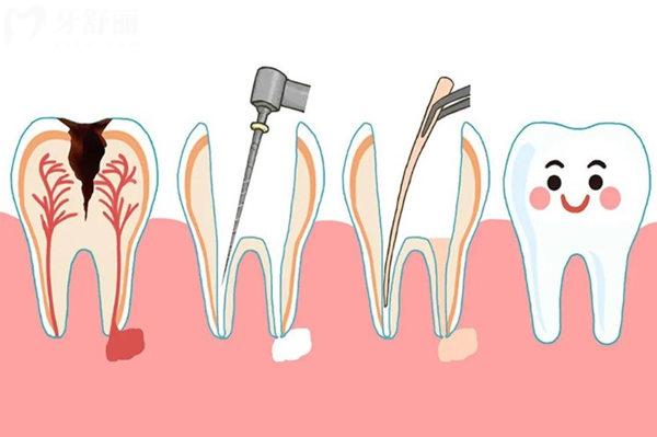 2026天津做根管治疗详细价格表!前门牙后牙儿牙价格全公开,附十大靠谱医院地址,绝绝子攻略速存！