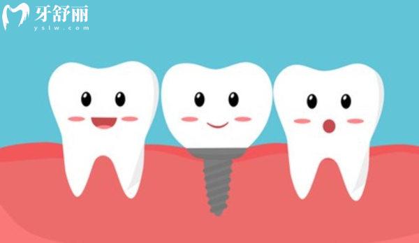 瑞士sic种植体属于什么档次?中高端实锤!质量