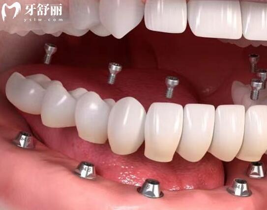 2026清远清口口腔医院收费标准上映~种植牙