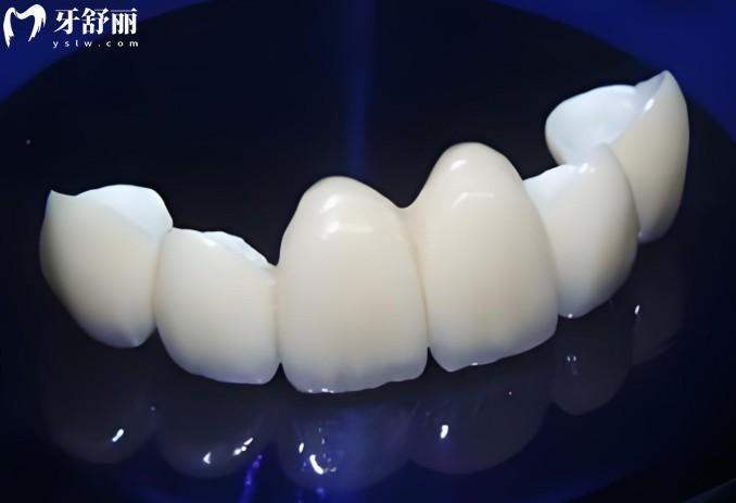 全瓷牙700元和1200元有什么区别? PK:材料/硬度等,看完不踩坑