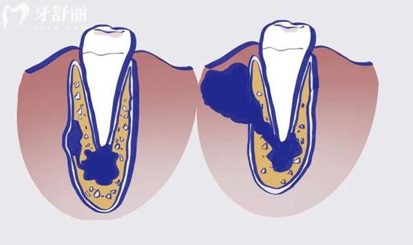 牙槽骨吸收了还能长回来吗?不能,植骨手术帮您解决,看完不慌