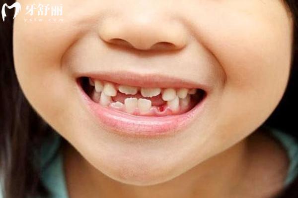 儿童牙齿矫正费用大概多少？