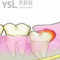 厦门登特口腔拔智齿多少钱？