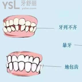 广州雅度口腔正雅隐形矫正双11优惠价格活动