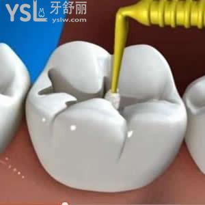 北京维乐口腔成人3m树脂补牙价格