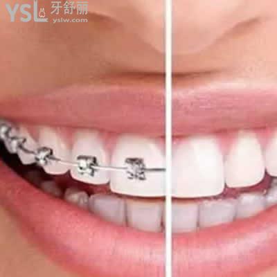深圳格伦菲尔口腔传统金属托槽牙齿矫正价格贵吗？