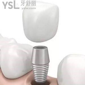 深圳拜尔口腔韩国登腾种植牙价格表