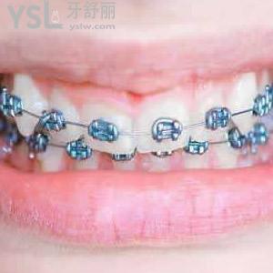 西安中诺口腔医院金属牙齿矫正价目表