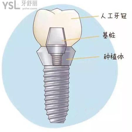 新公布广州瑞德口腔进口种植牙价格表